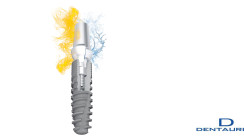 Einzigartiger Abutment Switch: Konus oder Zylinder für ein System