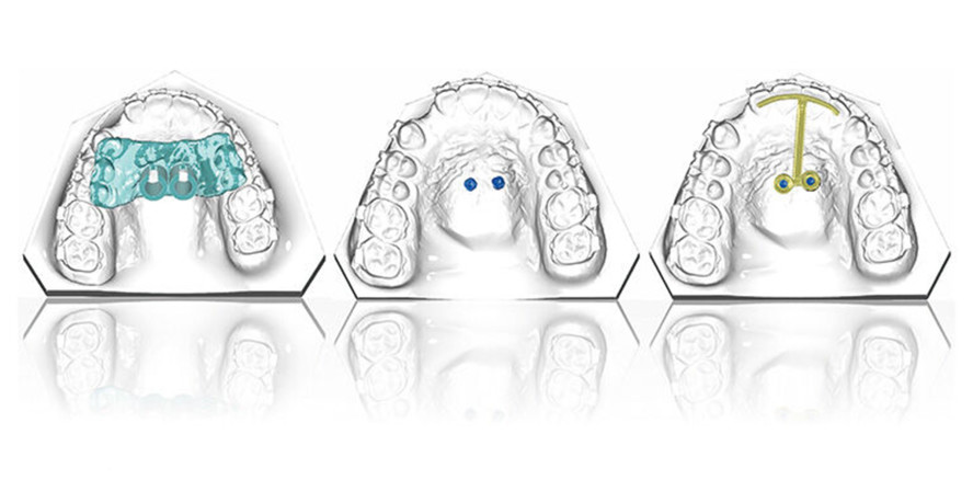 Herstellung von digital geplanten KFO-Apparaturen