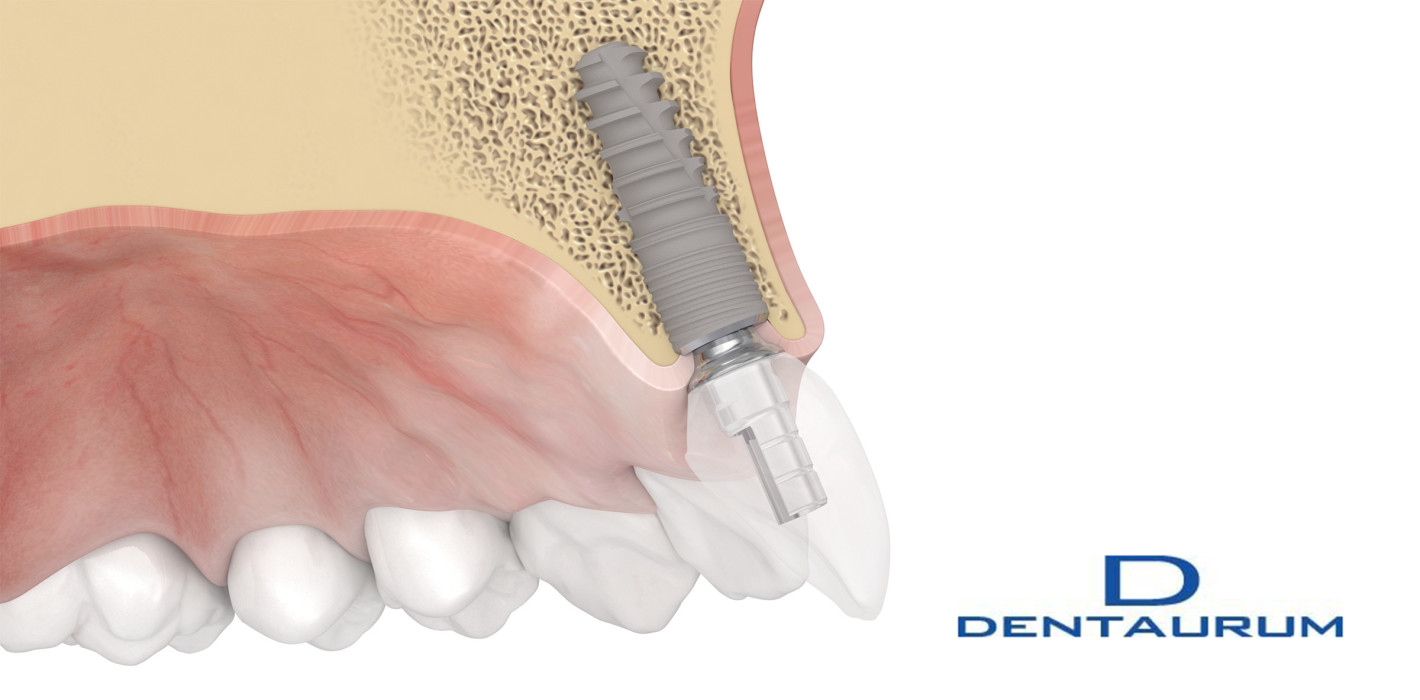Dentaurum Implants baut sein Sortiment weiter aus