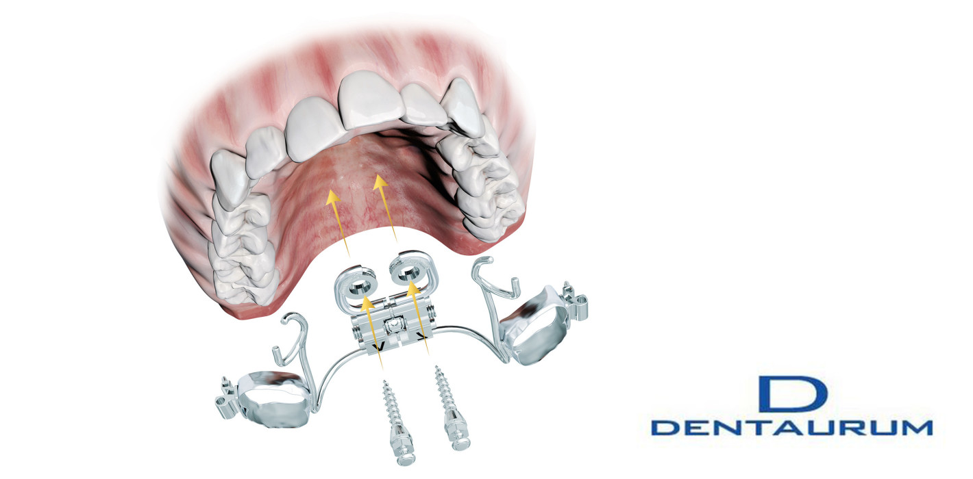 Volle Behandlungsfreiheit: Das neue tomas®-RPE eyelet