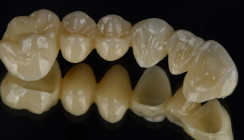 Cercon® yo ML: Smartes Zirkonoxid für eine hohe natürliche Ästhetik