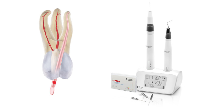 Der smarte Weg zur warm-vertikalen Obturation