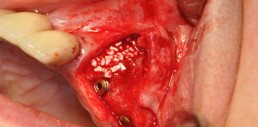 Erhalt der Kaufunktion bei einer älteren Patientin