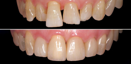 Farben bei Füllungsmaterialien: Die magische Zahl Fünf