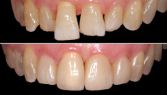 Farben bei Füllungsmaterialien: Die magische Zahl Fünf