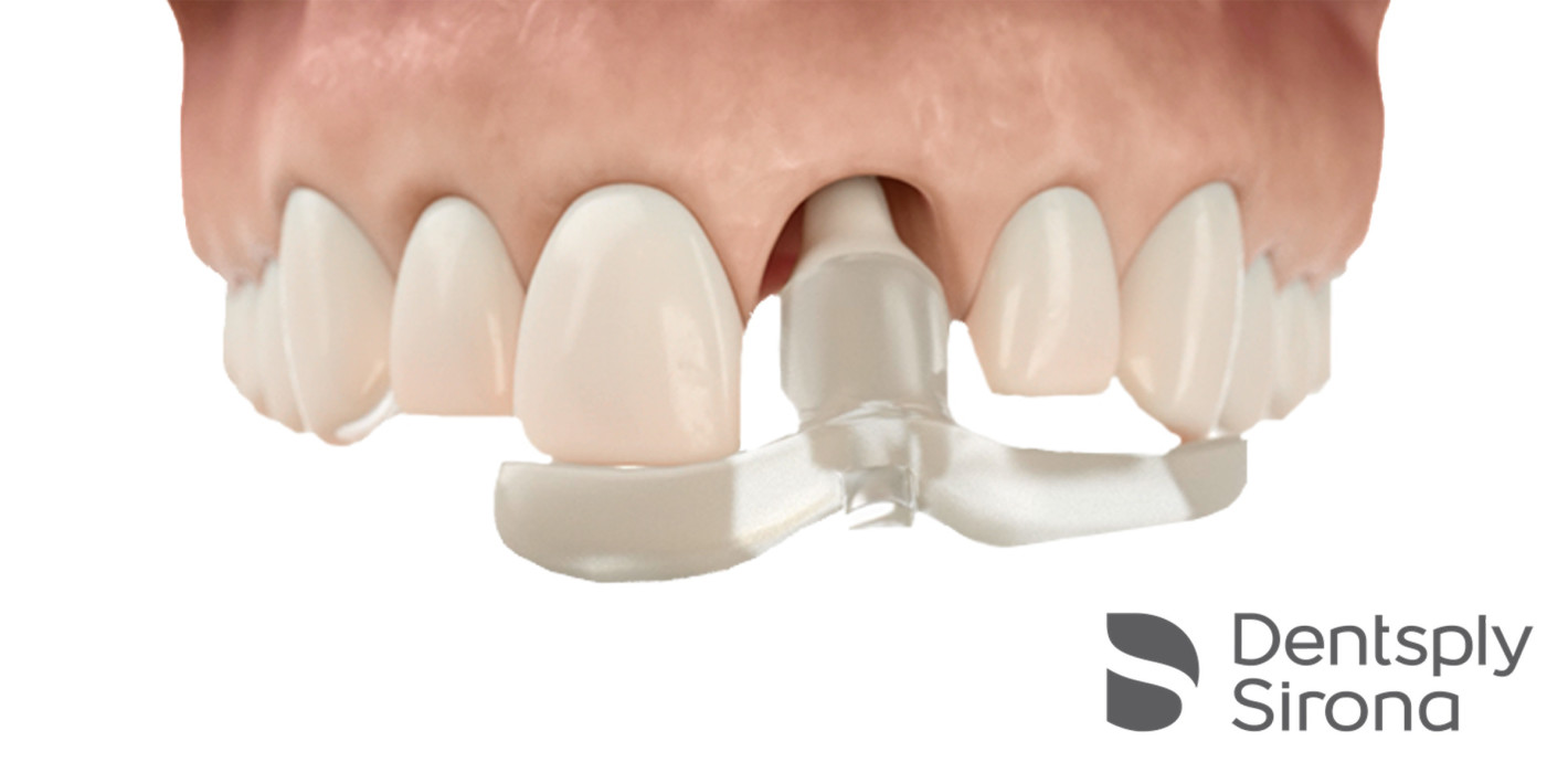 Präzise und zuverlässige Abutment-Platzierung