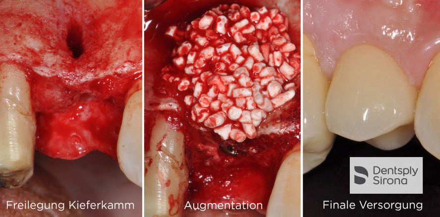 Dentsply Sirona  – Fallbericht: Augmentation mit phykogenem KAM