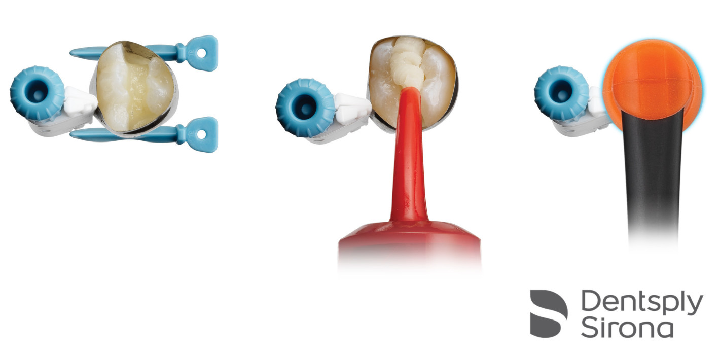 Komposithybrid Surefil one ist eine weiße Alternative zu Amalgam