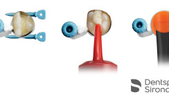Komposithybrid Surefil one ist eine weiße Alternative zu Amalgam