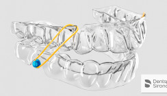 Dentsply Sirona: SureSmile Aligner – Ihre Patienten. Ihre Kontrolle.
