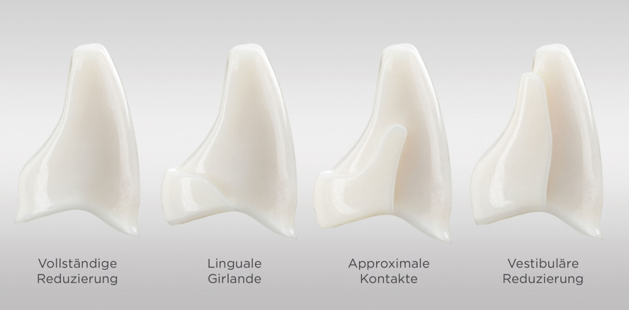 Vier Cut-back-Optionen für Atlantis-Kronen von Dentsply Sirona