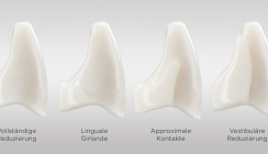 Vier Cut-back-Optionen für Atlantis-Kronen von Dentsply Sirona