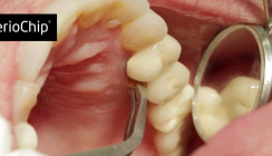 Laserlicht und Chlorhexidin: Ein starkes Team gegen Periimplantitis