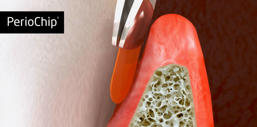 Kleiner Chip mit großer Wirkung