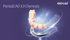 Partial CAD 3.3 Chemnitz von exocad bietet einen neuen Split-Prothesen-Workflow