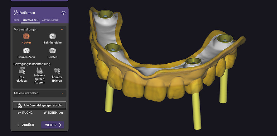 Split-Prothesen-Workflow in exocad DentalCAD 3.3 Chemnitz