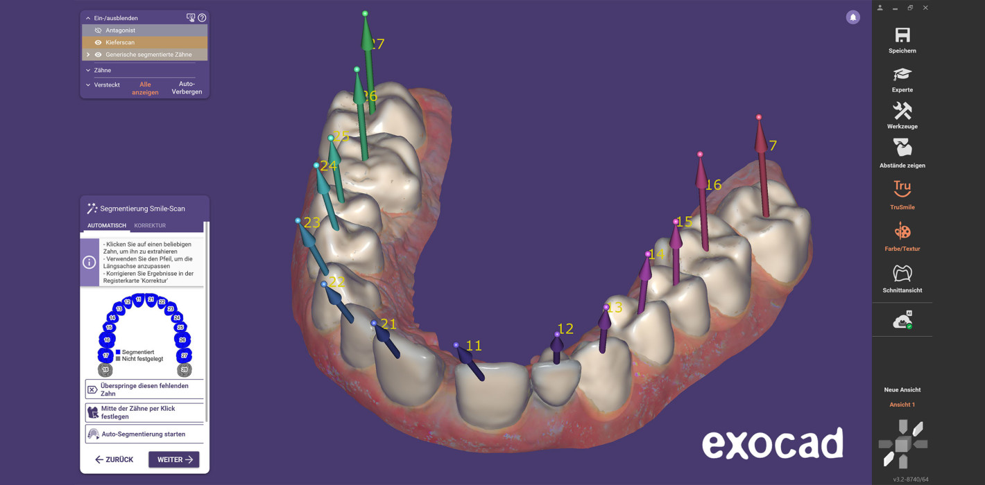 Neue Features des Moduls Smile Creator von exocad
