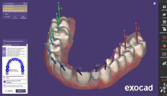 Neue Features des Moduls Smile Creator von exocad