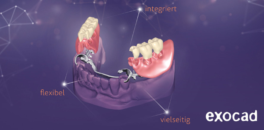 PartialCAD 3.0 Galway: Fantastische Designfreiheit für Teilprothesen