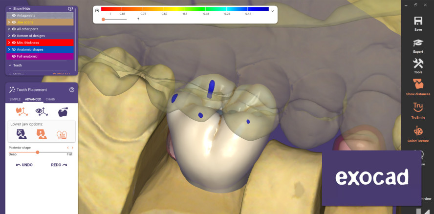 exocad gibt Roll-Out von DENTALCAD 3.0 GALWAY bekannt