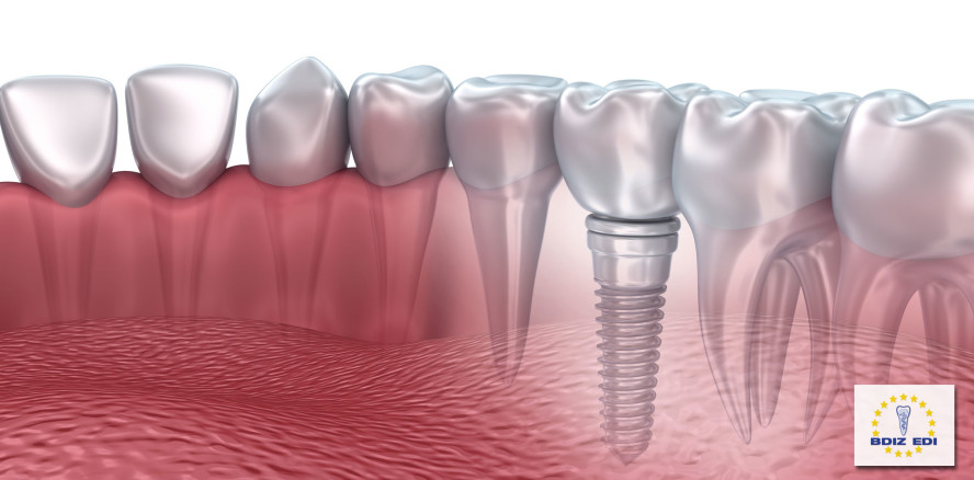 Jubiläum: 20. Curriculum Implantologie des BDIZ EDI gestartet