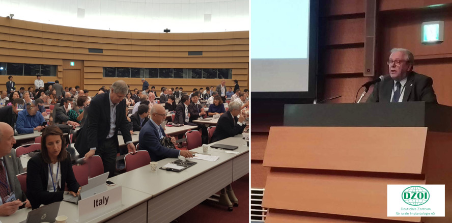 Verbindung zwischen Implantatkörper und -aufbau sollte unter 3 µm bleiben