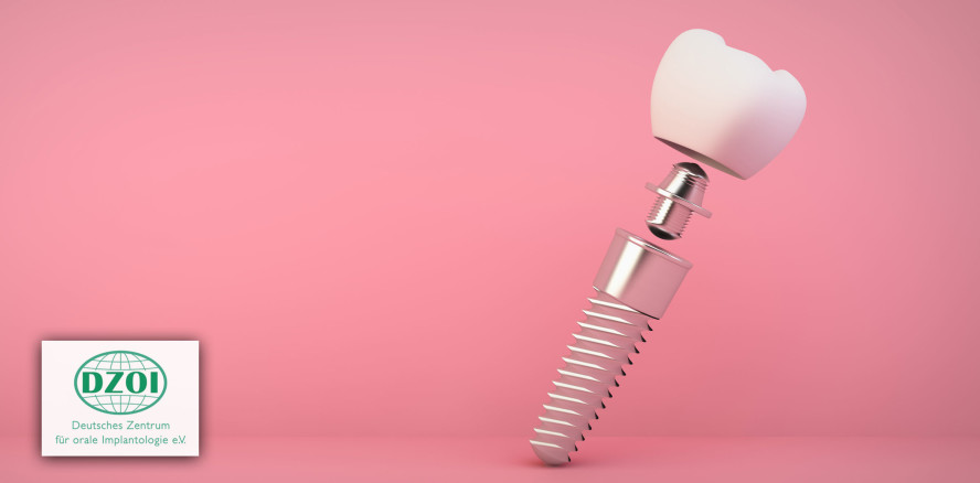 DZOI: Standards für Bezeichnungen des Implantats sind ein Muss