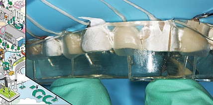 Behandlung eines Abrasionsgebisses mit der Injection-Moulding-Technik
