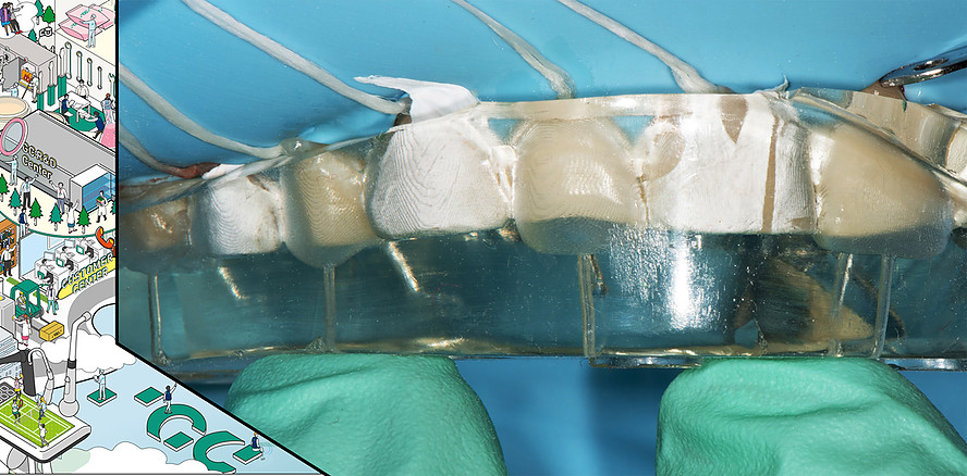 Behandlung eines Abrasionsgebisses mit der Injection-Moulding-Technik