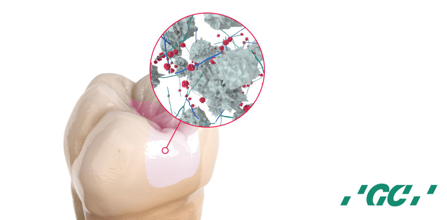 Die Suche nach einer wirklichen Amalgam-Alternative mit Glas-Hybrid