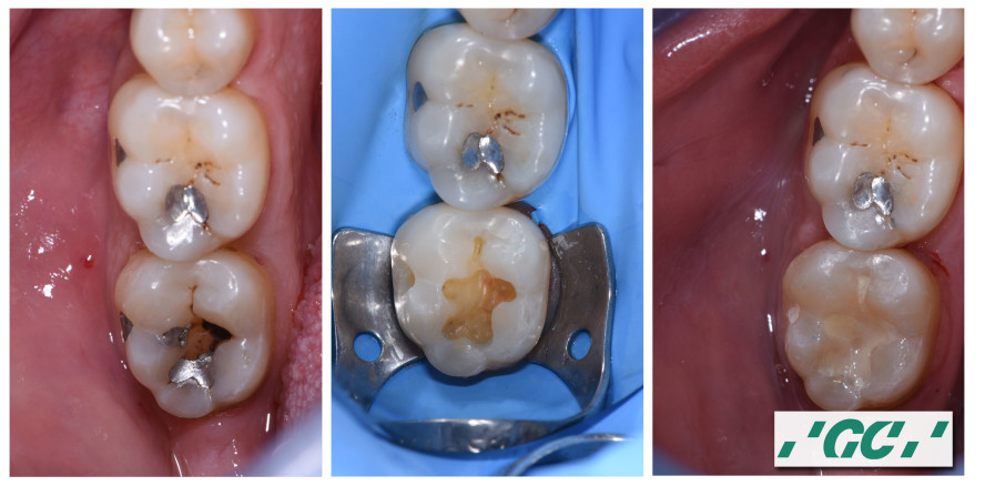 Passende Amalgam-Alternativen für jede Indikation
