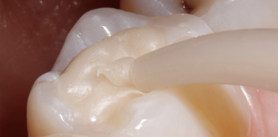 Amalgam-Verbot naht im Eiltempo ... Welche Alternativen gibt es?