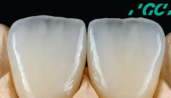 Ästhetische Herausforderungen in der Zahntechnik mit System lösen