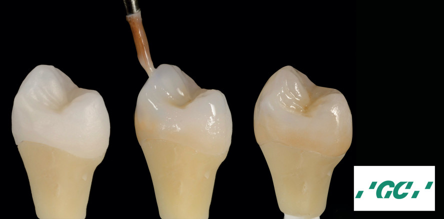 Hochästhetische Ergebnisse erzielen und wertvolle Zeit sparen