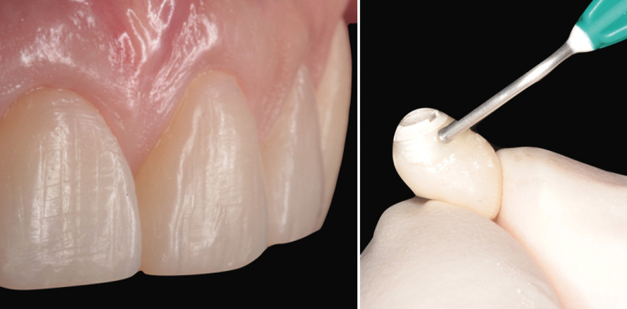 Injizieren statt Schichten – Wie ein Composite zum Allrounder wurde