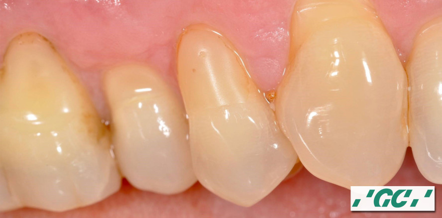 G-BOND von GC: Einfach in der Anwendung und dennoch beständig