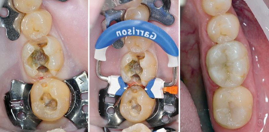 Anatomisch geformte Kontaktpunkte