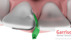 Garrison Dental: Fusion Anterior Frontzahnmatrizensystem