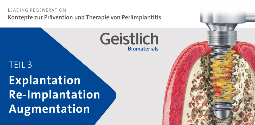 Zehn-Jahres-Daten zeigen: 90 Prozent Erfolg nach Re-Implantation