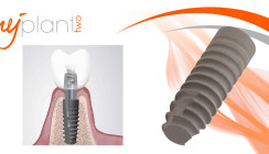 MyPlant II: Herausragendes Implantatsystem