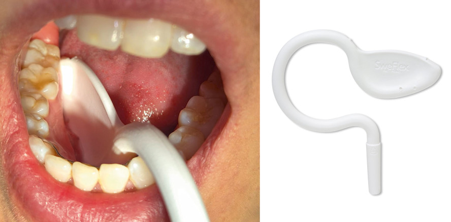 Freihändige Absaugung mit Swe-Flex – ungeahnte Freiheiten für die Anwendung