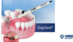 Microleakage bei Implantaten stoppen