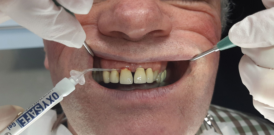 Parodontitis- und Periimplan­titis­therapie & Allgemeinerkrankungen