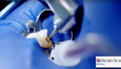 Probleme in der Endodontie vermeiden und lösen