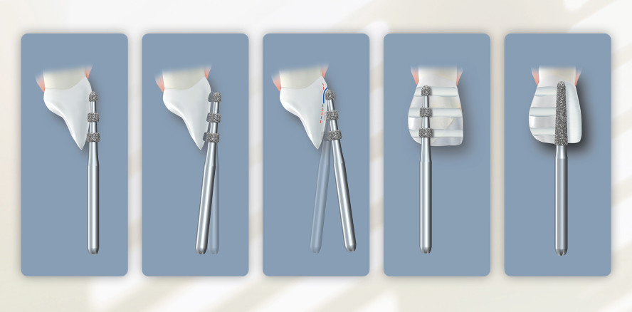 Step-by-Step: Keramikveneers substanzschonend präparieren