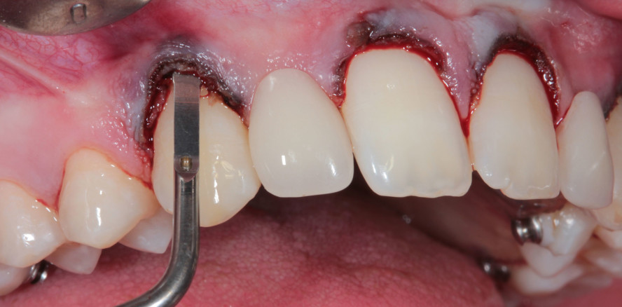 Minimalinvasive chirurgische Kronenverlängerung