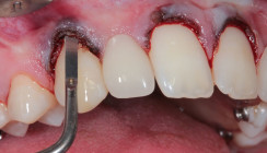 Minimalinvasive chirurgische Kronenverlängerung