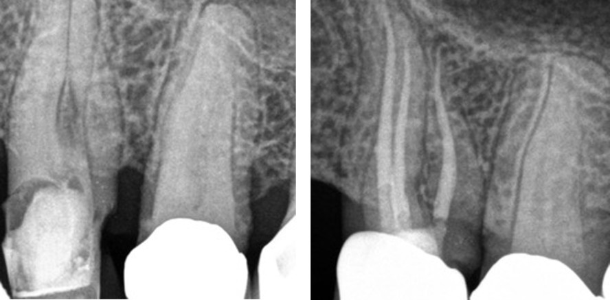 Biokeramische Sealer hinterfragen komplexe Obturationsmethoden