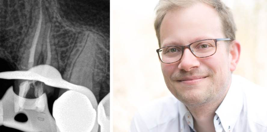 Biokeramische Sealer: Dimensions­stabilität mit Einstifttechnik