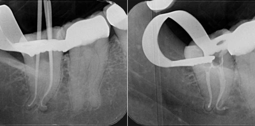 Challenge accepted: Aufbereitung bei Wurzel­kanalkrümmung